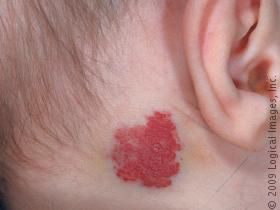 Hemangioma, from the lecture slides.