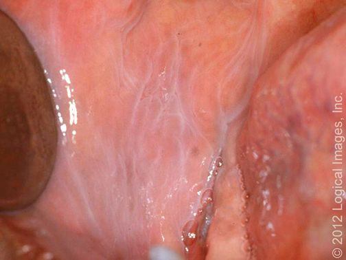 Leukoedema, from the lecture slides.