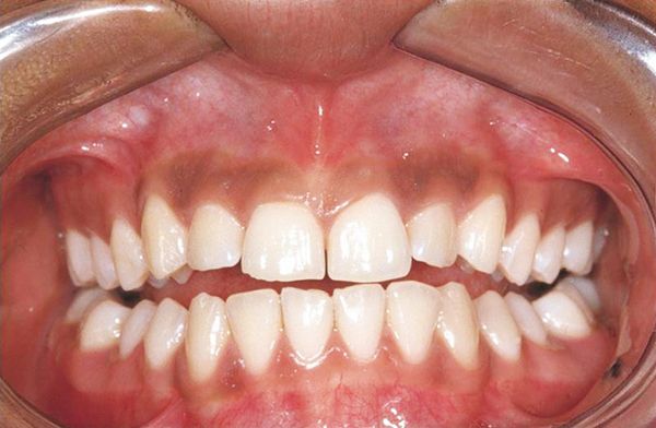 Physiologic pigmentation, from the lecture slides.