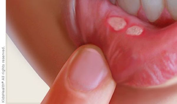 Aphthous stomatitis (canker sores), from the lecture slides.