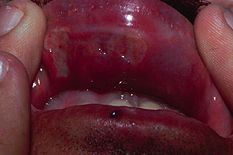 Behcet syndrome, from the lecture slides.