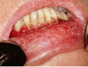 Oral lichen planus, from the lecture slides.