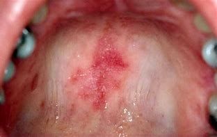 Systemic lupus erythematosus   oral, from the lecture slides.