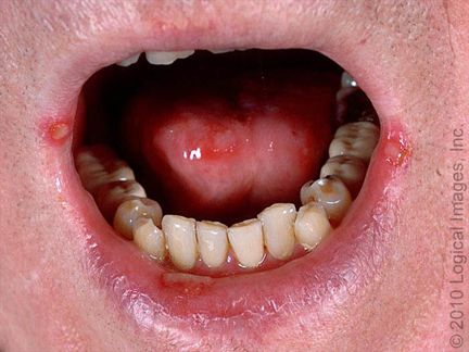 Herpes simplex ulcers, from the lecture slides.