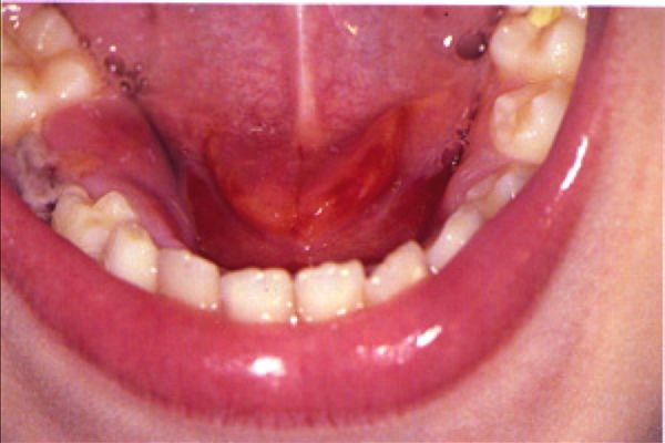 Acute suppurative sialadenitis, from the lecture slides.