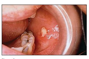 Sialolithiasis, from the lecture slides.