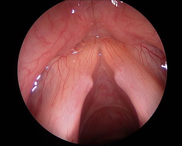 Vocal cord nodules, from the lecture slides.