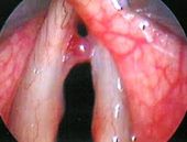Vocal cord polyps, from the lecture slides.