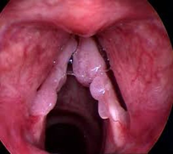 Vocal cord papillomatosis, from the lecture slides.