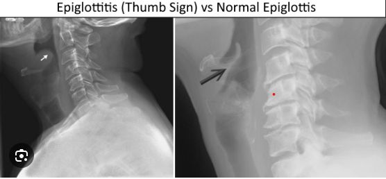 Epiglottitis (supraglottitis), from the lecture slides.