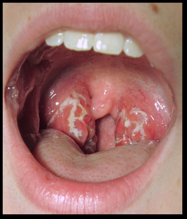 Bacterial pharyngitis (GABHS), from the lecture slides.
