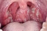 Infectious mononucleosis, from the lecture slides.
