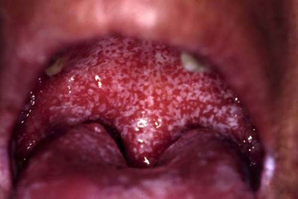 Oral candidiasis (thrush), from the lecture slides.