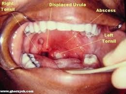 Peritonsillar abscess (quinsy), from the lecture slides.