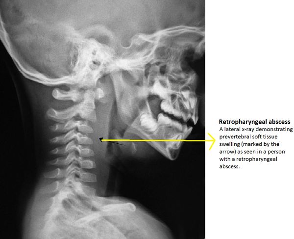 Retropharyngeal abscess, from the lecture slides.