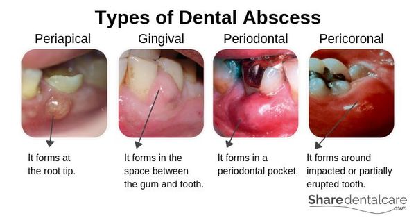 Dental abscess, from the lecture slides.