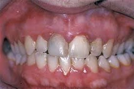 Gingivitis and periodontitis, from the lecture slides.