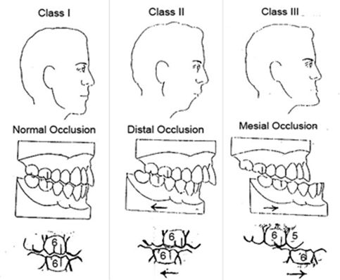 Malocclusion, from the lecture slides.