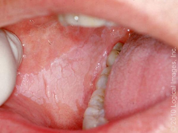 Oral leukoplakia, from the lecture slides.