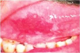 Erythroplakia, from the lecture slides.