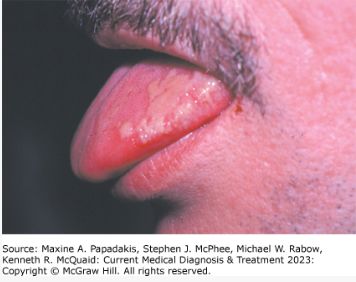 Hairy leukoplakia, from the lecture slides.
