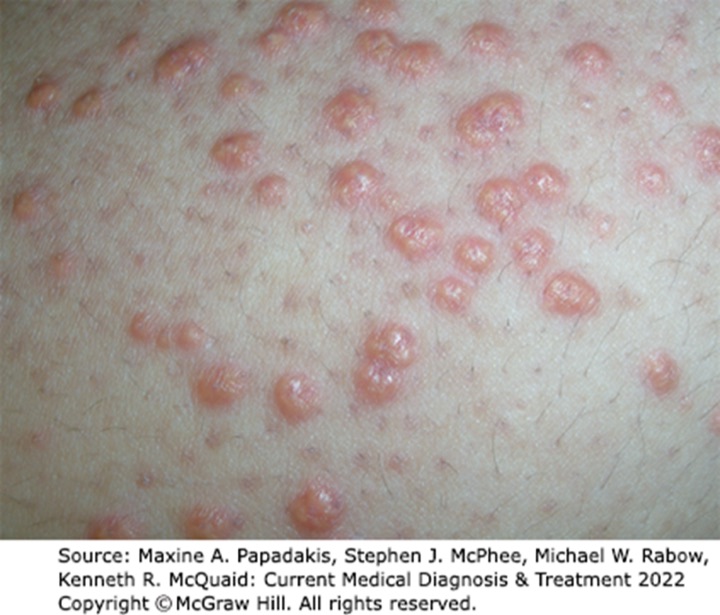 Eruptive xanthomas: clusters of small yellow-pink dome-shaped papules on the arm.
