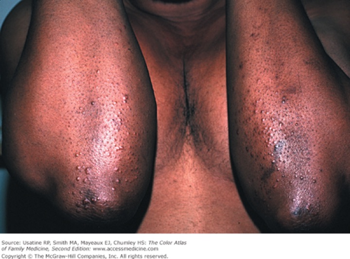 Eruptive xanthomas: many small papules over both elbows in a patient with dark skin.