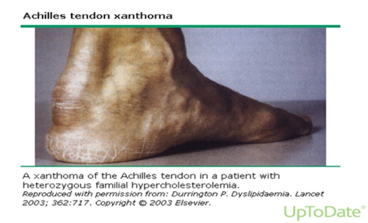 Achilles tendon xanthoma: a thickened, nodular Achilles tendon at the heel.