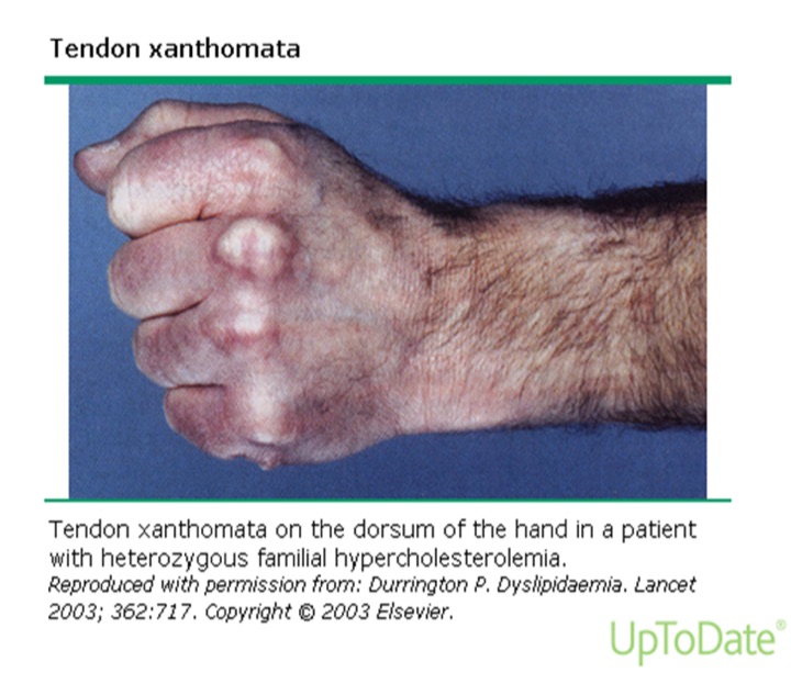 Tendon xanthomas: firm nodules over the extensor tendons on the back of a clenched hand.