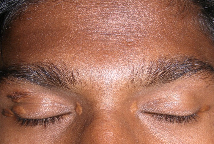 Xanthelasma in dark skin: small tan-yellow plaques near the inner corners of the eyelids.