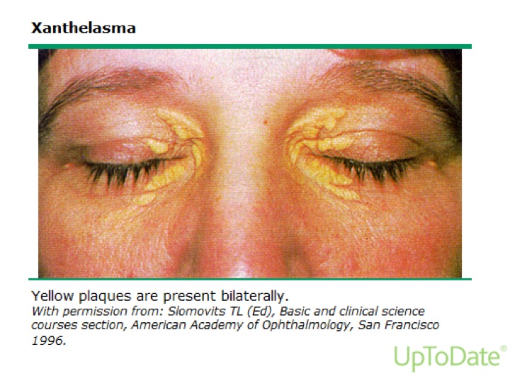 Xanthelasma: yellow plaques on the upper and lower eyelids near the inner corners of both eyes.