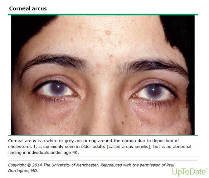 Corneal arcus: a white-gray ring at the edge of both corneas in a young woman.