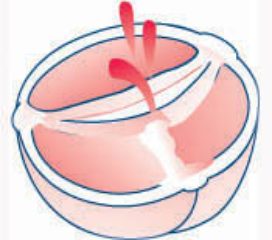 Drawing of an abnormal bicuspid aortic valve with two cusps and turbulent flow.