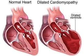 Cut-away of a normal heart beside a heart with dilated cardiomyopathy and an enlarged ventricle.