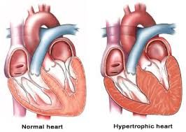 Cut-away of a normal heart beside a hypertrophic heart with a thick left ventricular wall and a small cavity.