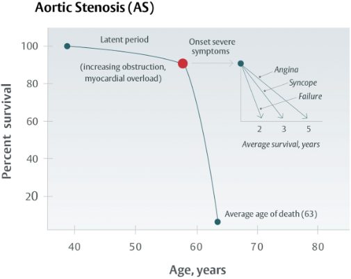 Graph of percent survival against age in aortic stenosis: a long latent period, onset of severe symptoms near age 60, then a steep fall, with average survival after angina 5 years, syncope 3 years and failure 2 years.