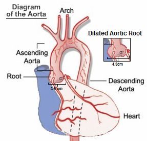 Diagram of the aorta showing the root, ascending aorta, arch and descending aorta, with an inset of a dilated aortic root labeled 4.5 cm against a normal 3.5 cm.