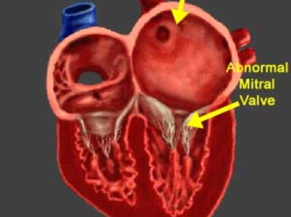Cut-away drawing of a heart with a markedly enlarged left atrium and an arrow to the abnormal, thickened mitral valve.
