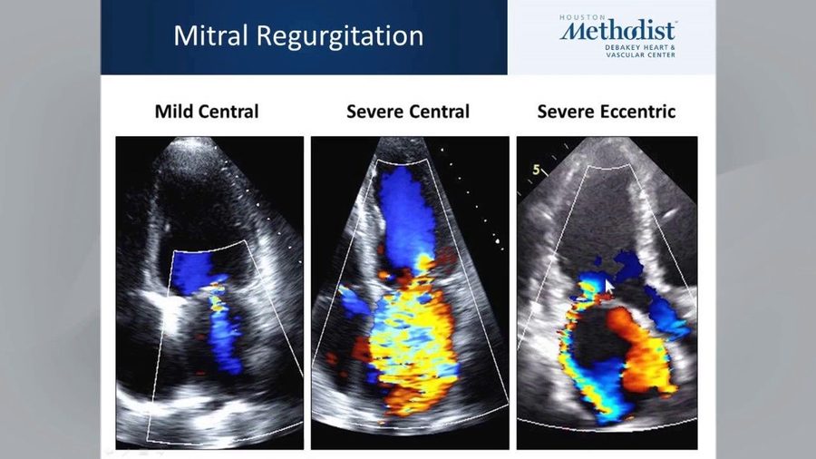 Three color-Doppler echocardiogram panels of mitral regurgitation labeled mild central, severe central and severe eccentric jets.