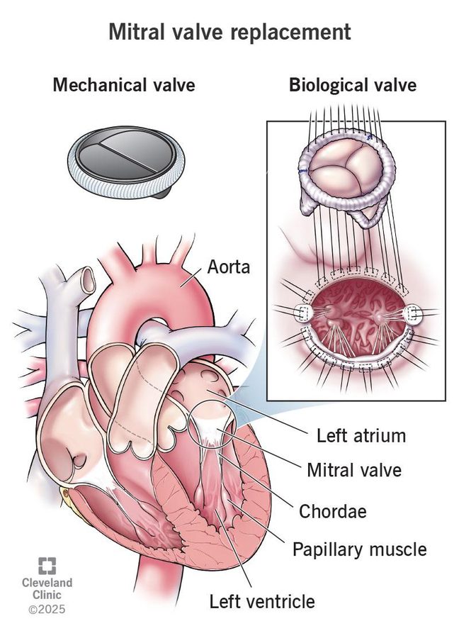 Illustration of mitral valve replacement comparing a mechanical bileaflet disc valve with a biological tissue valve sewn to the mitral annulus, with the aorta, left atrium, chordae, papillary muscle and left ventricle labeled.