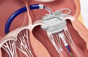 Illustration of a catheter-delivered stented valve seated in the mitral annulus.