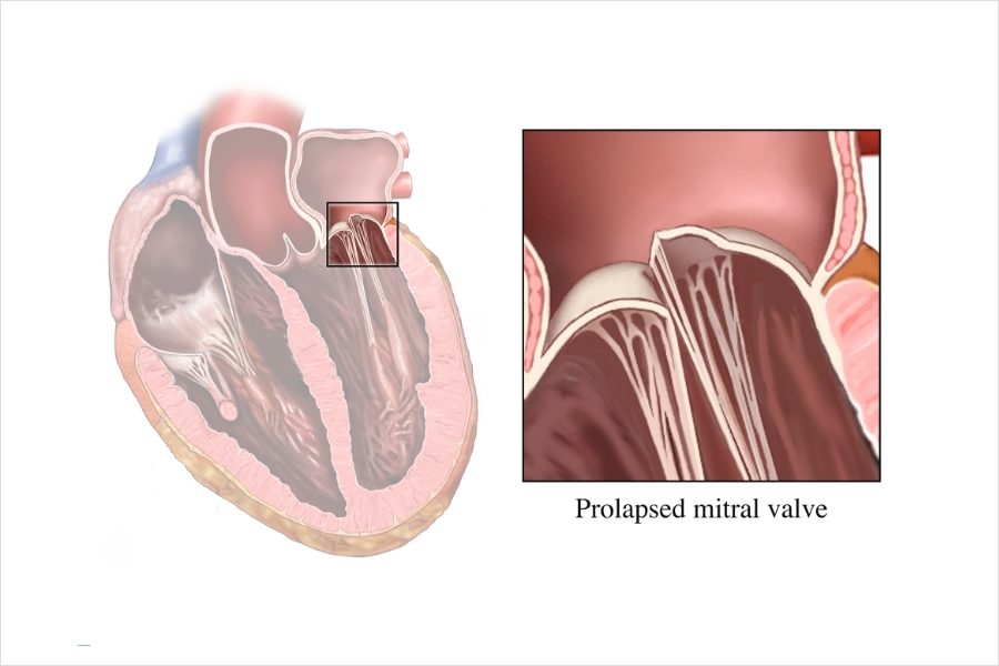 Illustration of a heart with the mitral valve boxed and an enlarged inset of a prolapsed mitral leaflet bowing up into the left atrium.