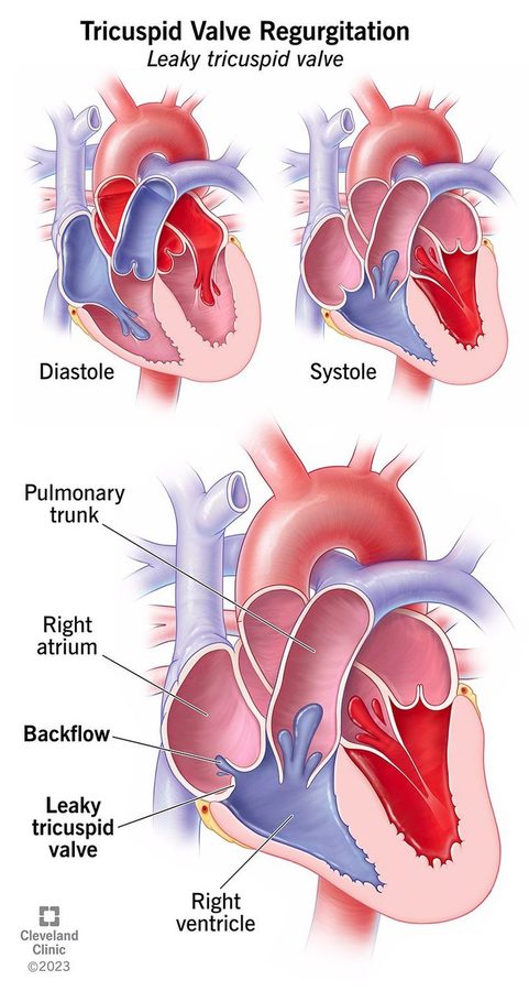 Illustration of tricuspid valve regurgitation: diastole and systole views and a labeled view showing backflow through a leaky tricuspid valve from the right ventricle into the right atrium.