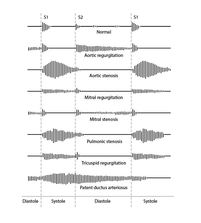 Phonocardiogram chart across S1, S2 and S1 showing murmur shapes: normal; aortic regurgitation decrescendo after S2; aortic stenosis crescendo-decrescendo in systole; mitral regurgitation holosystolic; mitral stenosis diastolic rumble after an opening click; pulmonic stenosis crescendo-decrescendo in systole; tricuspid regurgitation holosystolic; patent ductus arteriosus continuous.