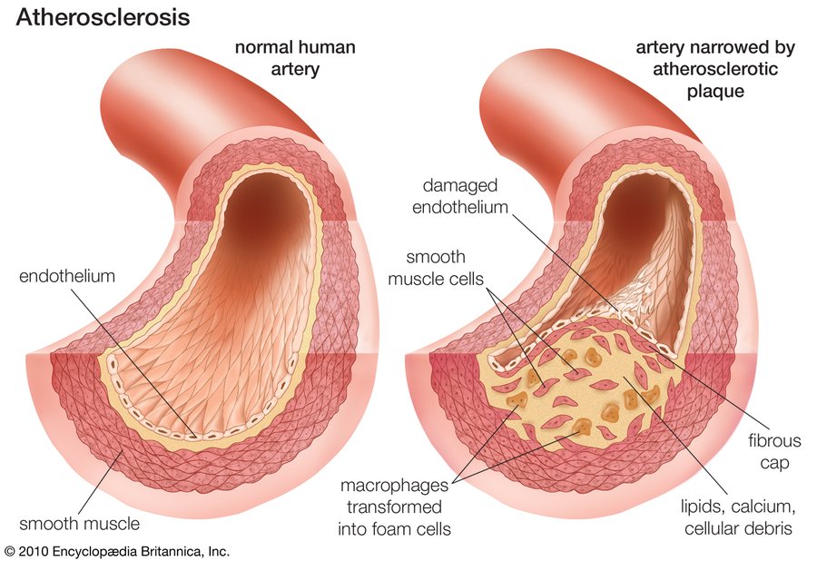 Illustration comparing a normal artery with an artery narrowed by atherosclerotic plaque, labeling damaged endothelium, smooth muscle cells, macrophages transformed into foam cells, the fibrous cap, and lipids, calcium and cellular debris.