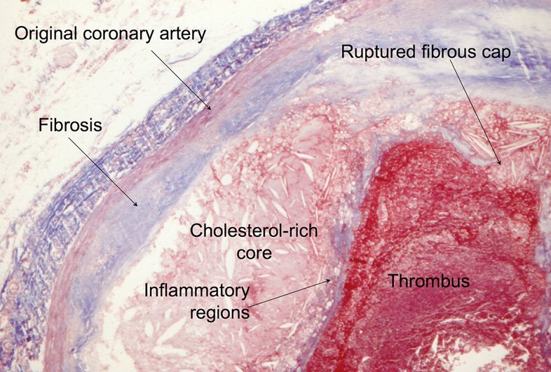 Stained section of a coronary artery labeling the original artery, fibrosis, a ruptured fibrous cap, a cholesterol-rich core, inflammatory regions and thrombus.