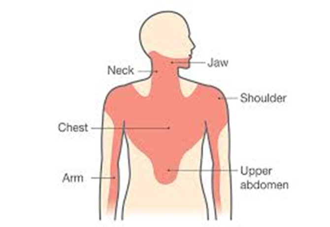 Body outline shading the chest, neck, jaw, left shoulder, arm and upper abdomen as areas of referred cardiac pain.