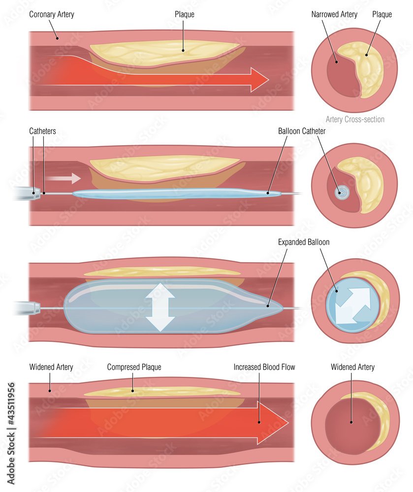 Illustration of balloon angioplasty: a coronary artery narrowed by plaque, a balloon catheter advanced, the balloon expanded, and the widened artery with compressed plaque and increased blood flow, no stent left behind.