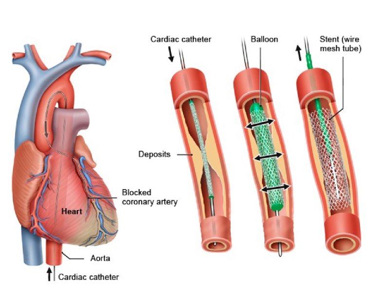 Illustration of percutaneous coronary intervention: a cardiac catheter reaches a blocked coronary artery, a balloon inflates, and a wire-mesh stent is left in place.