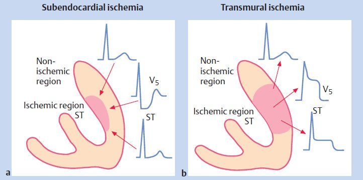 Two heart cross-sections: subendocardial ischemia of the inner wall produces ST depression in the overlying lead; transmural ischemia through the full wall produces ST elevation.